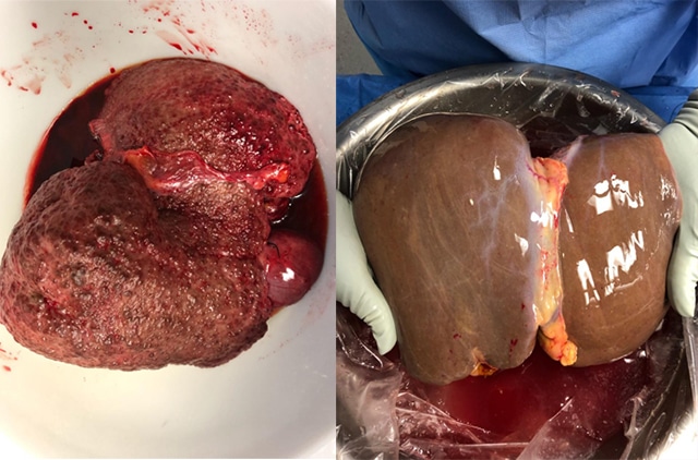 Diseased liver pictured left next to a healthy liver.