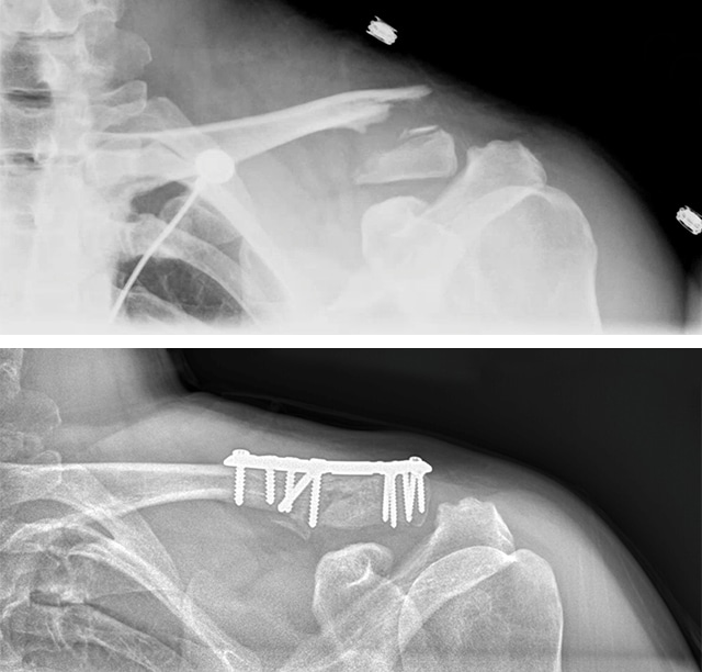 X-rays of shoulder after a bike crash sent motocross rider to the hospital.