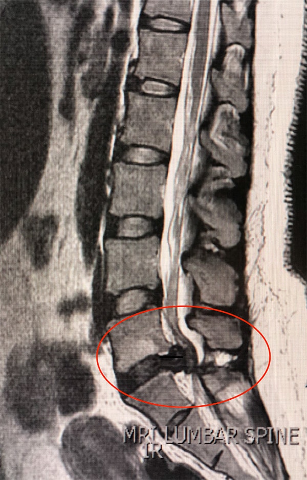 Patient's scan shows rare spine condition.
