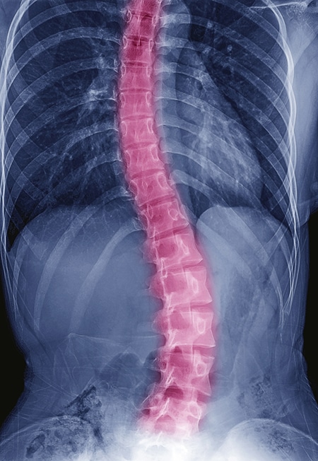 photo of x-ray of spine of person living with scoliosis